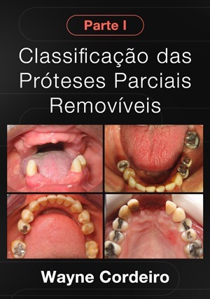 Cover for Classificação das Próteses Parciais Removíveis - Parte I