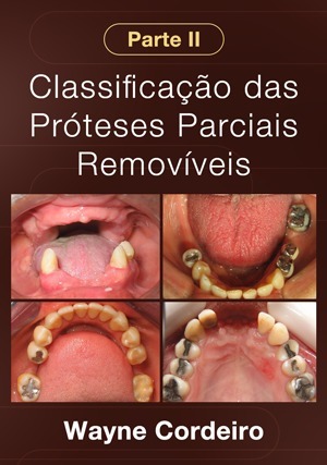 Cover for Classificação das Próteses Parciais Removíveis - Parte II