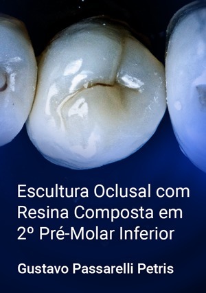 Cover for Escultura Oclusal com Resina Composta em 2º Pré-Molar Inferior