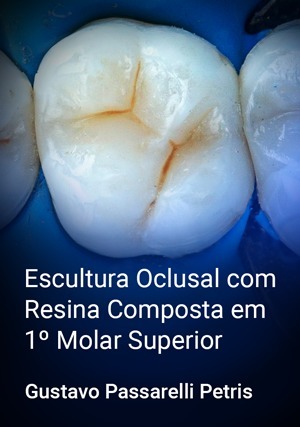 Cover for Escultura Oclusal com Resina Composta em 1º Molar Superior