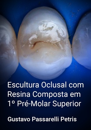 Cover for Escultura Oclusal com Resina Composta em 1º Pré-Molar Superior