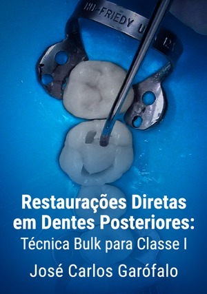 Cover for Restaurações Diretas em Dentes Posteriores: Técnica Bulk para Classe I