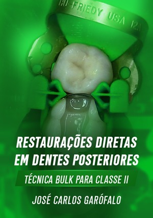 Cover for Restaurações Diretas em Dentes Posteriores: Técnica Bulk para Classe II