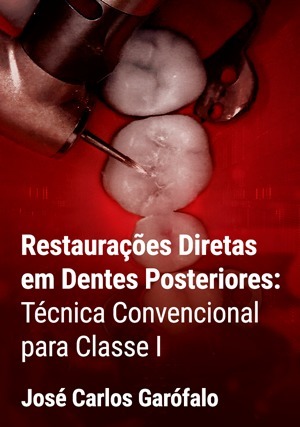 Cover for Restaurações Diretas em Dentes Posteriores: Técnica Convencional para Classe I