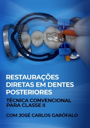 Cover for Restaurações Diretas em Dentes Posteriores: Técnica Convencional para Classe II