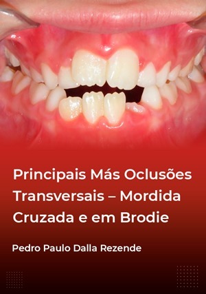 Cover for Principais Más Oclusões Transversais: Mordida Cruzada e em Brodie