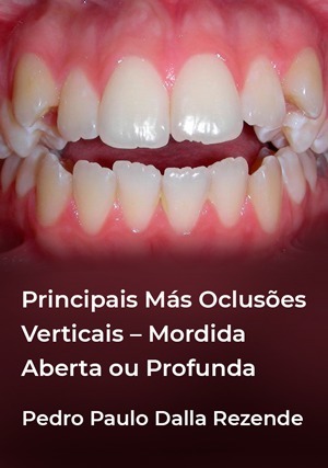 Cover for Principais Más Oclusões Verticais: Mordida Aberta ou Profunda