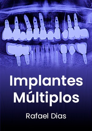 Cover for Implantes Múltiplos