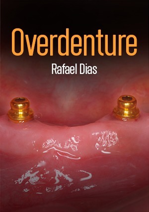 Cover for Overdenture