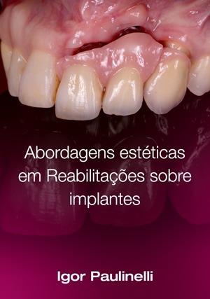 Cover for Implantes em Área Estética: Desafios e Possibilidades Clínicas