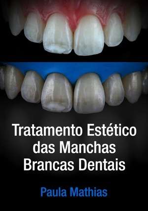 Cover for Tratamento Estético das Manchas Brancas Dentais