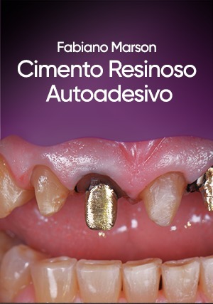 Cover for Cimento Resinoso Autoadesivo