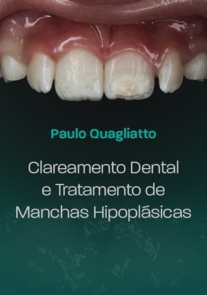 Cover for Clareamento Dental e Tratamento de Manchas Hipoplásicas