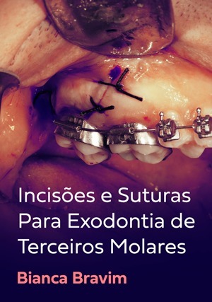 Cover for Incisões e Suturas Para Exodontia de Terceiros Molares