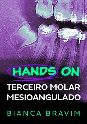 Cover for Terceiro Molar Mesioangulado