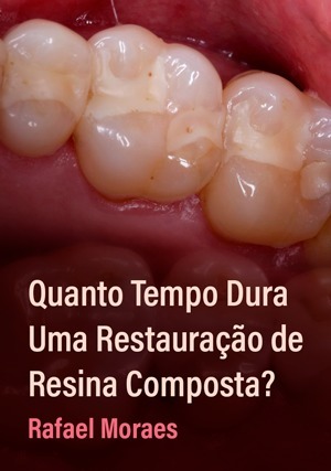 Cover for Quanto Tempo Dura Uma Restauração de Resina Composta?