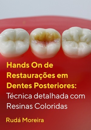 Cover for Hands On de Restaurações em Dentes Posteriores: Técnica Detalhada com Resinas Coloridas
