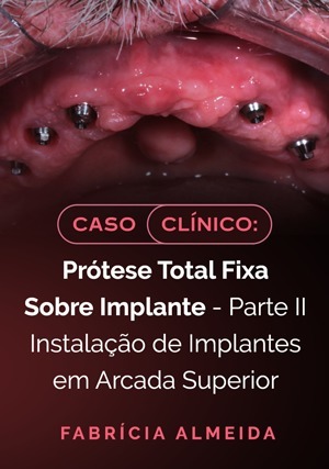 Cover for Caso Clínico: Prótese Total Fixa Sobre Implante - Parte II Instalação de Implantes em Arcada Superior