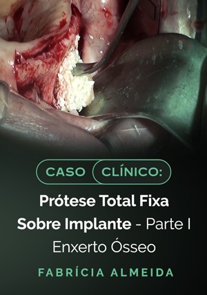 Cover for Caso Clínico: Prótese Total Fixa Sobre Implante - Parte I Enxerto Ósseo