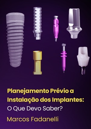 Cover for Planejamento Prévio a Instalação dos Implantes: O Que Devo Saber?