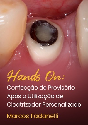 Cover for Hands On: Confecção de Provisório Após a Utilizaçāo de Cicatrizador Personalizado