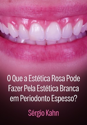 Cover for O Que a Estética Rosa Pode Fazer Pela Estética Branca em Periodonto Espesso?