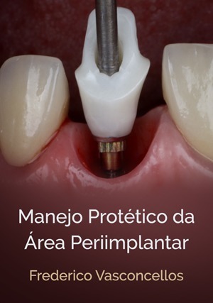 Cover for Manejo Protético da Área Periimplantar
