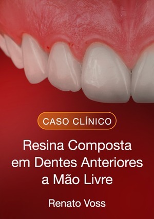 Cover for Resina Composta em Dentes Anteriores a Mão Livre