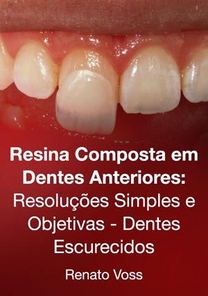 Cover for Resina Composta em Dentes Anteriores: Resoluções Simples e Objetivas - Dentes Escurecidos