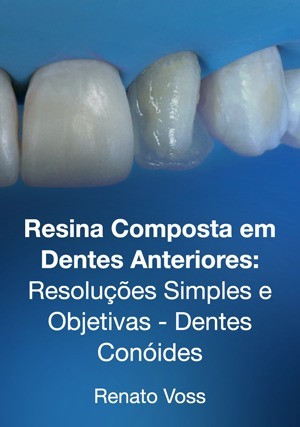 Cover for Resina Composta em Dentes Anteriores: Resoluções Simples e Objetivas - Dentes Conóides