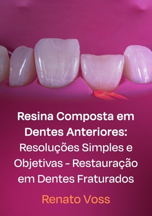Cover for Resina Composta em Dentes Anteriores: Resoluções Simples e Objetivas - Restauração em Dentes Fraturados