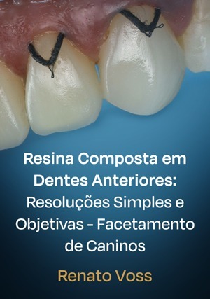 Cover for Resina Composta em Dentes Anteriores: Resoluções Simples e Objetivas - Facetamento de Caninos