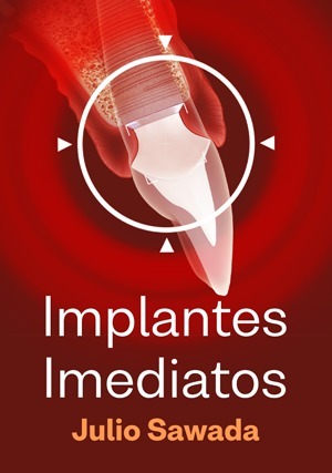 Cover for Implantes Imediatos