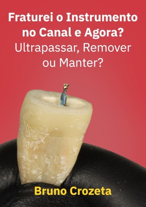 Cover for Fraturei o Instrumento no Canal e Agora? Ultrapassar, Remover ou Manter?
