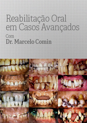 Cover for Reabilitação Oral em Casos Avançados