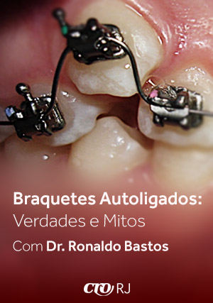 Cover for Sistema de Braquetes Autoligados: Verdades e Mitos