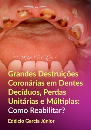 Cover for Grandes Destruições Coronárias em Dentes Decíduos, Perdas Unitárias e Múltiplas: Como Reabilitar?