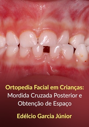 Cover for Ortopedia Facial em Crianças: Mordida Cruzada Posterior e Obtenção de Espaço