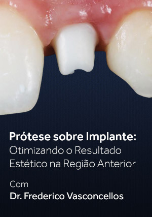 Cover for Prótese sobre Implante: Otimizando o Resultado Estético na Região Anterior