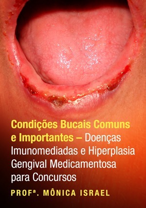 Cover for Condições Bucais Comuns e Importantes: Doenças Imunomediadas e Hiperplasia Gengival Medicamentosa Para Concursos