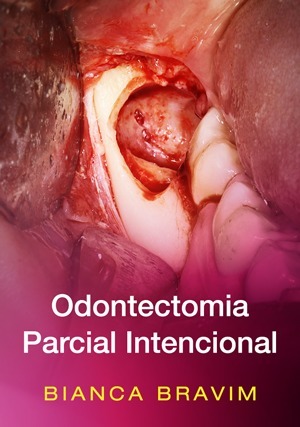 Cover for Odontectomia Parcial Intencional