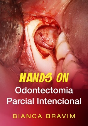 Cover for Hands On: Odontectomia Parcial Intencional
