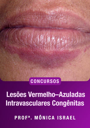 Cover for Lesões Vermelho– Azuladas Intravasculares Congênitas Para Concursos