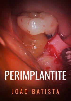 Cover for Periimplantite