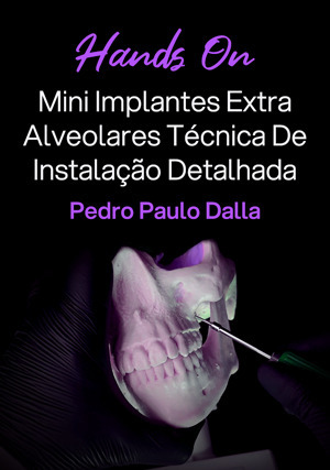 Cover for Hands on: Mini Implantes Extra Alveolares Técnica De Instalação Detalhada