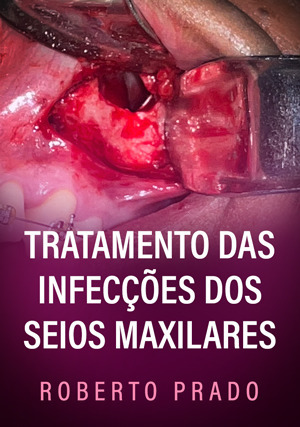 Cover for Tratamento das Infecções dos Seios Maxilares