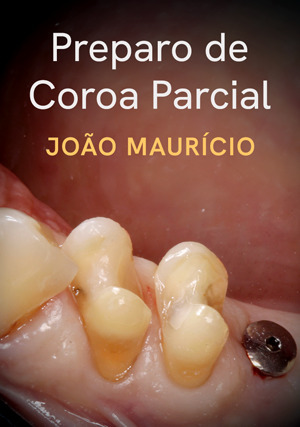 Cover for Preparo de Coroa Parcial