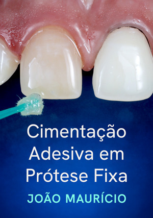 Cover for Cimentação Adesiva em Prótese Fixa