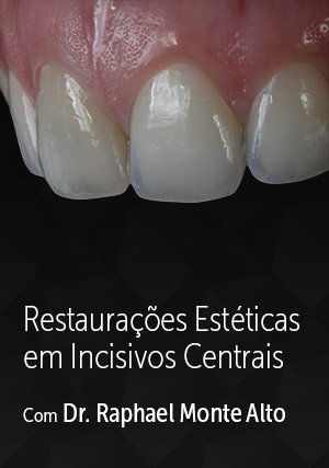 Cover for Restaurações Estéticas em Incisivos Centrais