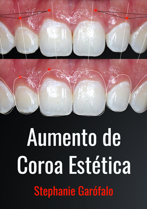 Cover for Aumento de Coroa Estética